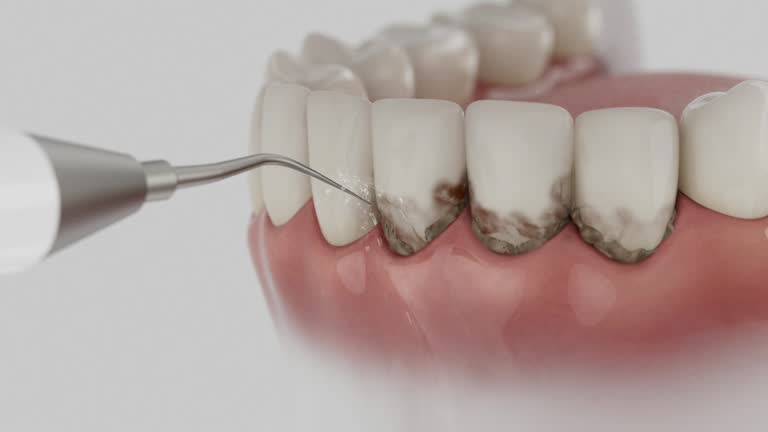 Trusted Wisdom Tooth Removal service in Chandler, IN - Dentist Open Now